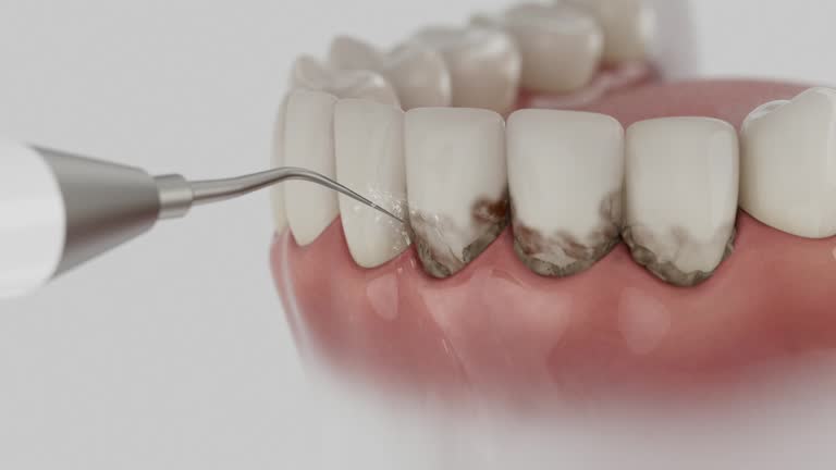Reliable Dental Implants contractor in Marion, IN by Smile Center Dentistry